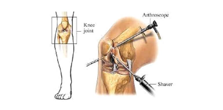Arthroscopic Knee Surgery